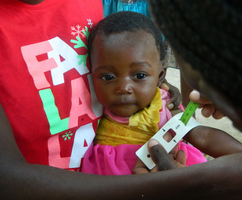 A little girl is checked for malnutrition in a clinic in Malawi A little girl is checked for malnutrition in a clinic in Malawi